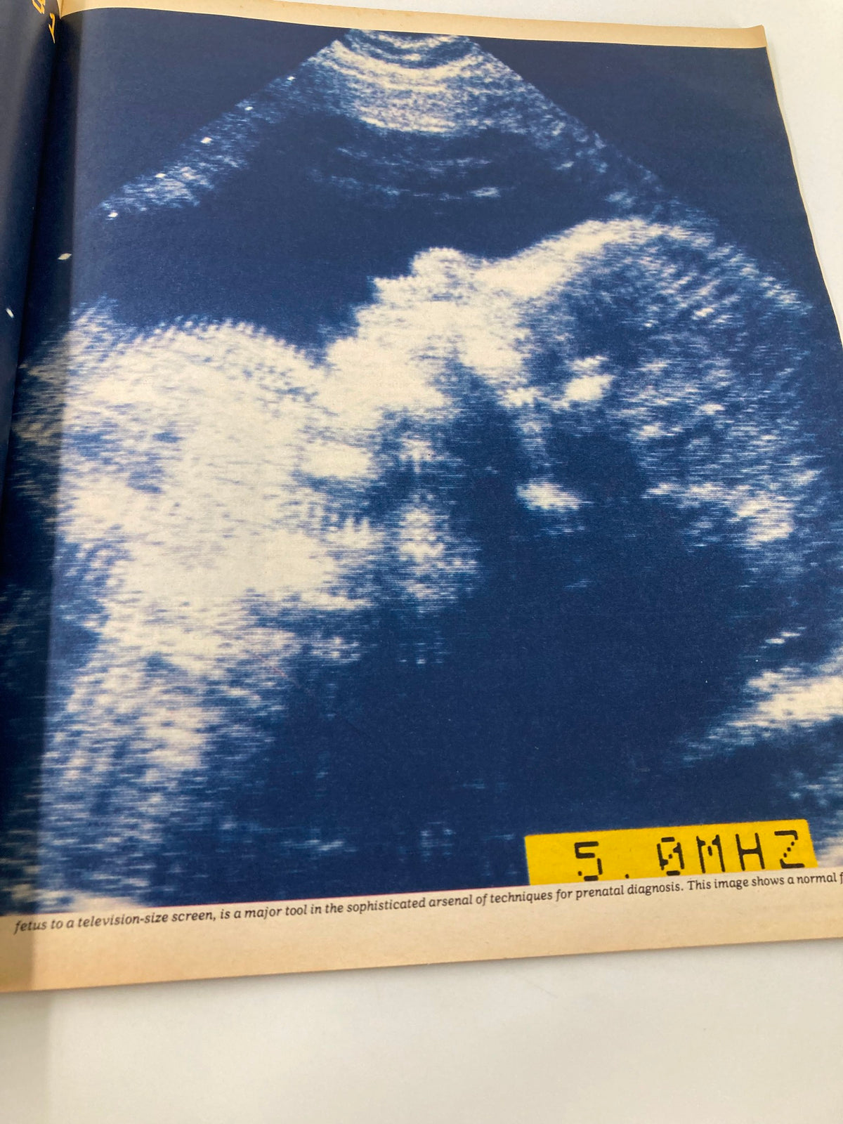 Ultrasound image page from VTG The New York Times Magazine February 28, 1982, highlighting advanced prenatal diagnostic techniques.