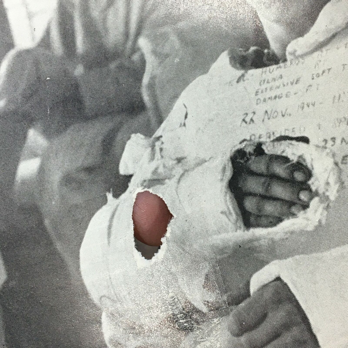 Close-up detail from the VTG Life Magazine January 29 1945, focusing on Soldier George Lott's injured arm and the medical notes visible on his bandages, highlighting the severity of his wartime injuries.
